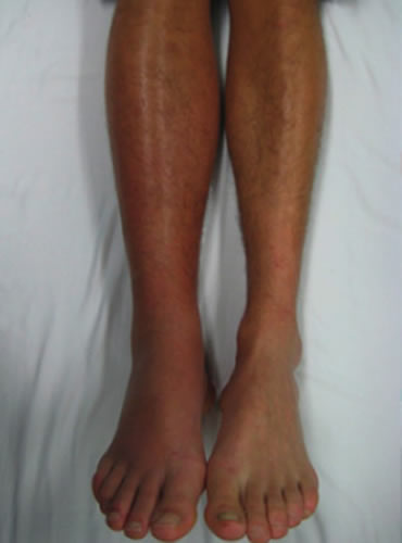 King's Thrombosis Centre - Venous Thromboembolism VTE patient with VTE in leg